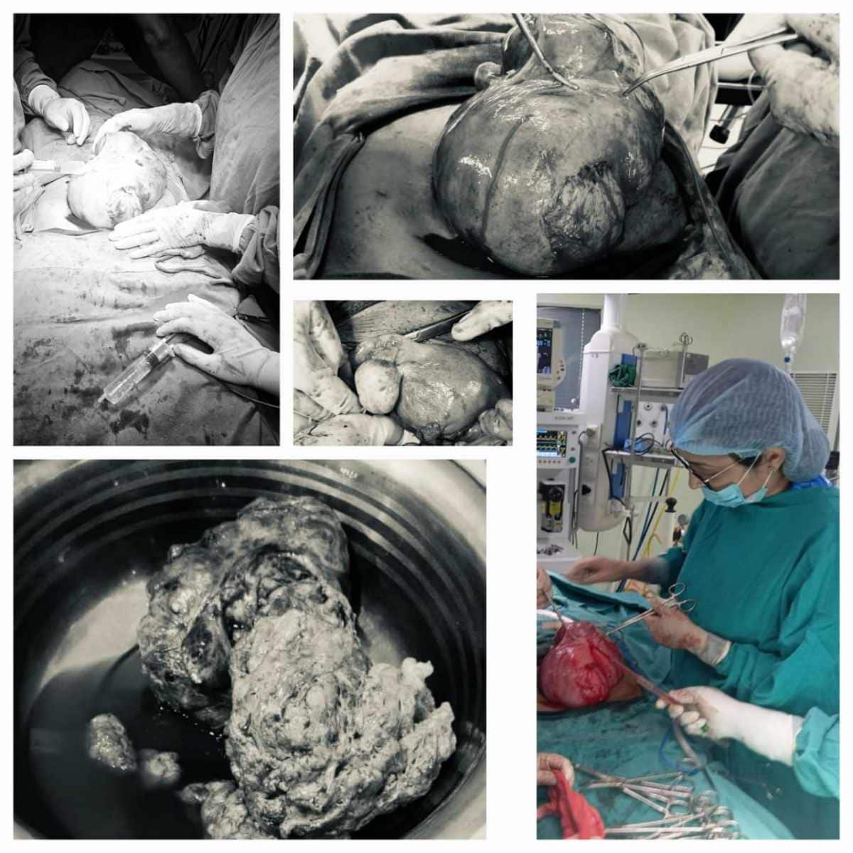 Diagnosis of fibroids, Uterine fibroids, Uterine Fibroids symptoms, case study, medical case, medical case of uterine fibroid, removal of fibroid from uterus, massive fibroid growth on uterus, preserving womb while removing fibroid, preserving fibroid while removing womb, young patient fibroid removal from uterus