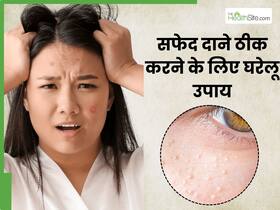 चेहरे के सफेद दाने (मिलिया) ठीक करने के लिए अपनाएं ये 5 घरेलू उपाय, दूर होगी समस्या और खूबसूरत बनेगी स्किन