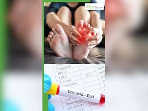 कौन सी दाल खाने से यूरिक एसिड बढ़ता है