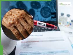 Dangerous Mpox Variant Clade 1b Detected In England: Highly Virulent Monkeypox Virus May Be Spreading Undetected In UK