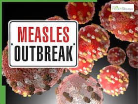 Deadly Measles Outbreak Explodes Across US: Texas Becomes Epicenter With Over 500 Infections And 2 Deaths Deadly Measles Outbreak Explodes Across US: Texas Becomes Epicenter With Over 500 Infections And 2 Deaths