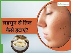 लहसुन से तिल कैसे हटाएं? जानें 5 तरीके, जिनसे अनचाहे तिल और मस्से हो जाएंगे गायब