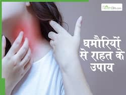 हीटवेट और पसीने के कारण बढ़ सकती हैं घमौरियां, इन 2 घरेलू उपायों से पाएं आराम