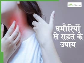 हीटवेट और पसीने के कारण बढ़ सकती हैं घमौरियां, इन 2 घरेलू उपायों से पाएं आराम