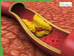 High Cholesterol Management: 7 Summer Drinks To Lower LDL Bad Cholesterol Levels Naturally Without Antibiotics