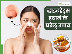 चेहरे से व्हाइटहेड्स हटाने के लिए आजमाएं ये 5 घरेलू उपाय, मिलेगी निखरी-बेदाग त्वचा