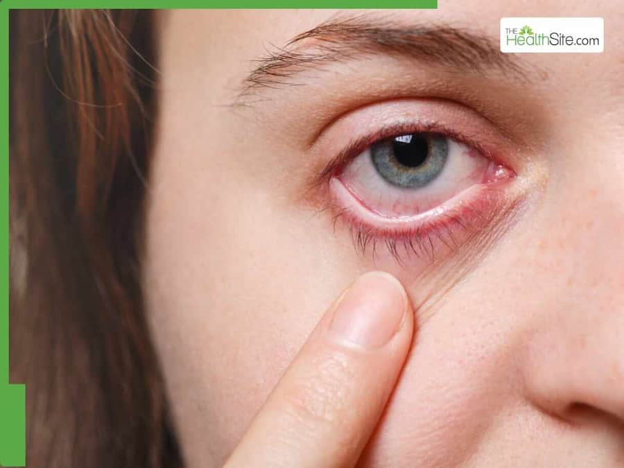 What Is An Eye Stroke: Know About Its Causes, Symptoms, Prevention Methods Amid Hot Weather Conditions