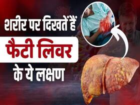 फैटी लिवर होने पर शरीर में दिखते हैं इस तरह के लक्षण फैटी लिवर होने पर शरीर में दिखते हैं इस तरह के लक्षण