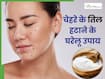 बिना सर्जरी चेहरे से तिल और काले मस्से कैसे हटाएं? जानिए 5 सबसे असरदार घरेलू नुस्खे
