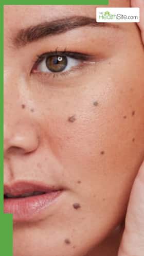 चेहरे के तिल हटाने के लिए क्या करें?