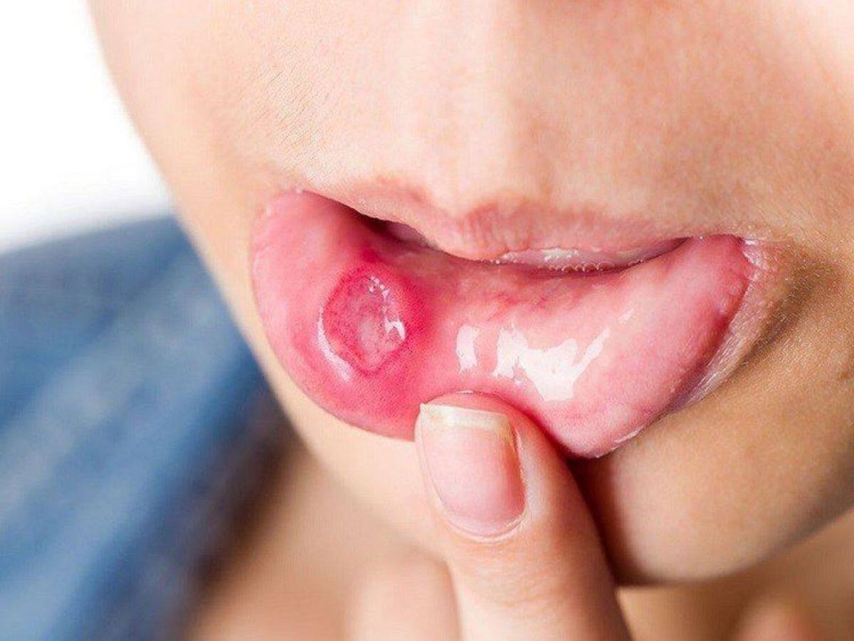 mouth ulcer