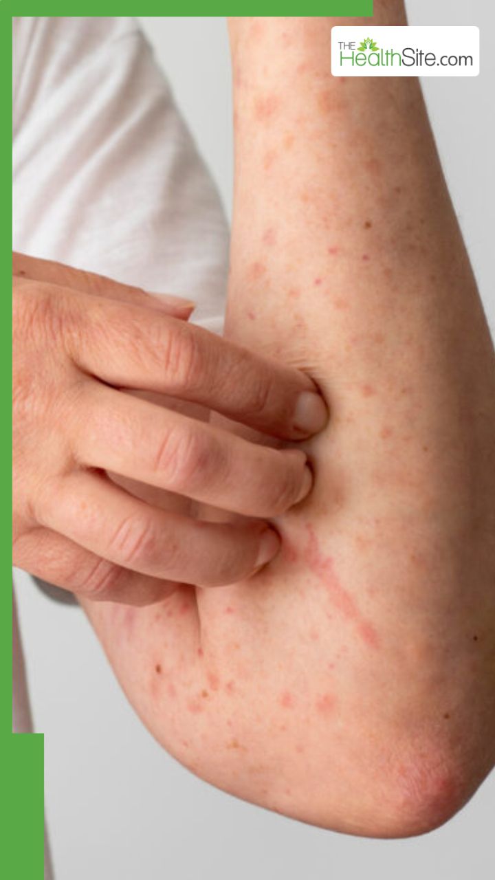 घमौरियां मिटाने के लिए क्या लगाएं?