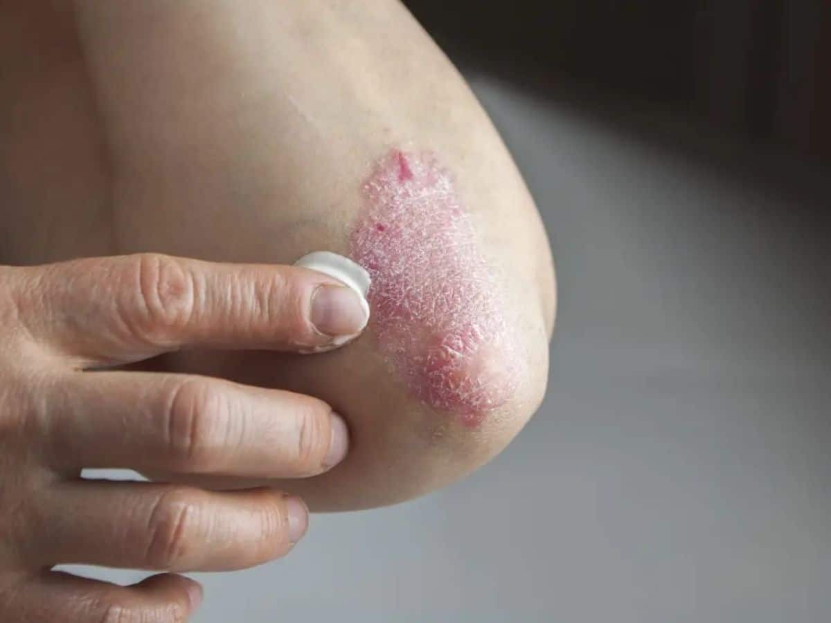 psoriasis symptoms