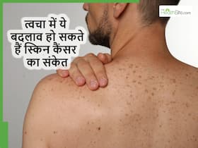 गर्मियों में स्किन पर दिखने वाले ये लक्षण भी हो सकते हैं Skin Cancer का संकेत, अभी से कर लें इनकी पहचान