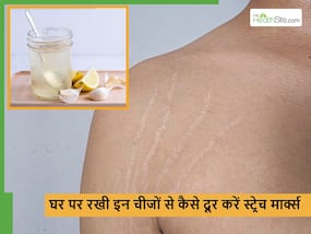 अब आपको भी स्ट्रेच मार्क्स से परेशान होने की जरूरत नहीं, आसानी से मिलने वाली इन 5 चीजों से दूर होंगे ये जिद्दी निशान