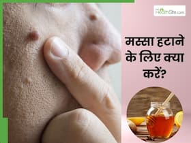 मस्सा हटाने के लिए क्या करें? जानें 4 सबसे असरदार घरेलू उपाय