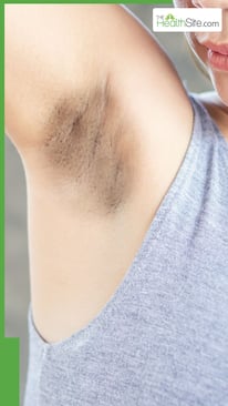 अंडरआर्म्स का कालापन कैसे दूर करें?