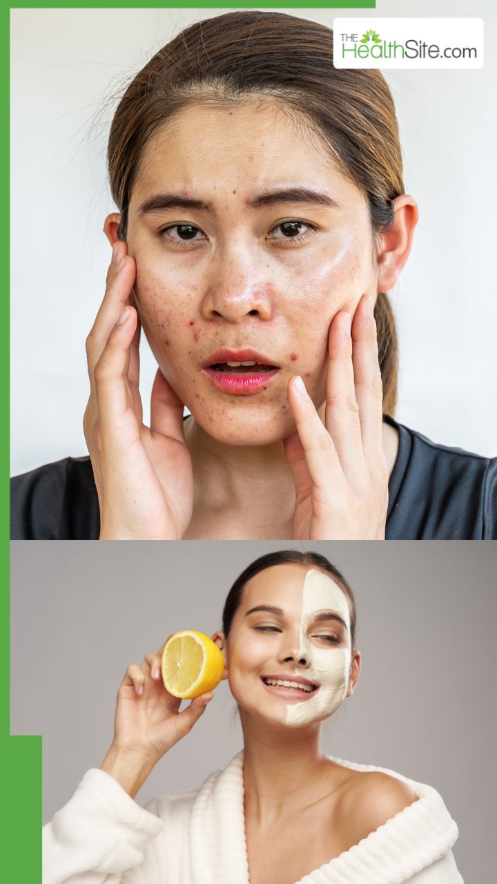 ऑयली स्किन के लिए 7 बेस्ट फेस पैक