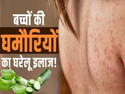 बच्चों की घमोरियों का इलाज करेंगे ये घरेलू उपाय