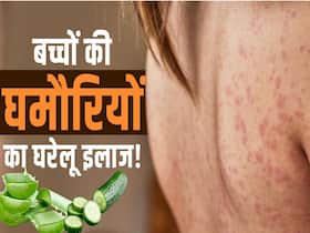 बच्चों की घमोरियों का इलाज करेंगे ये घरेलू उपाय