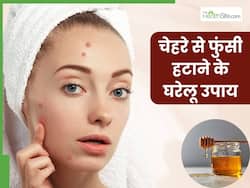 चेहरे से फुंसी कैसे हटाएं? जानें 5 असरदार घरेलू उपाय, जो पिंपल्स से दिलाएंगे छुटकारा