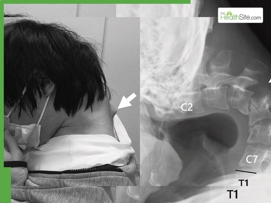 Man In Japan Diagnosed With Rare 'Dropped Head Syndrome' After Excessive Smartphone Use: Doctor Issues Warning