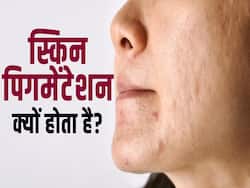 स्किन की पिगमेंटेशन का दूर करेंगे ये घरेलू उपाय
