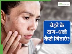 गर्मी में चेहरे के दाग-धब्बे मिटाने के लिए क्या लगाएं? इन 5 चीजों को लगाने से मिट जाएगी डार्कनेस