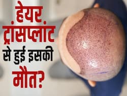 हेयर ट्रांसप्लांट के बाद क्यों हुई इस व्यक्ति की मौत? जानें कहां हुई लापरवाही