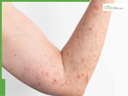 Everything Parents Need To Know About Dealing With Heat Rash In Children