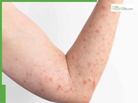 Everything Parents Need To Know About Dealing With Heat Rash In Children Everything Parents Need To Know About Dealing With Heat Rash In Children