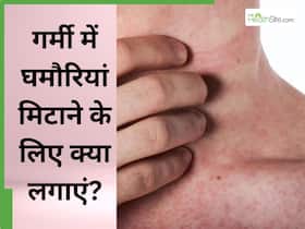 गर्मी में घमौरियां मिटाने के लिए क्या लगाएं? जानें 5 चीजें, जिनसे बेदाग भी बन जाएगी त्वचा