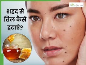 शहद से चेहरे के तिल कैसे हटाएं? जानें 5 तरीके, जिनसे निकल जाएंगे सारे काले तिल और मस्से