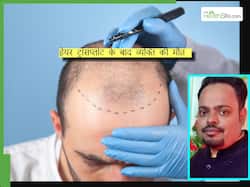 हेयर ट्रांसप्लांट कराने के बाद कानपुर में 2 लोगों की मौत, जानिए किन गलतियों के कारण जानलेवा बन जाती है यह प्रक्रिया