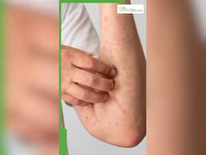 गर्मियों में घमौरियों से बचने के लिए करें ये 8 काम