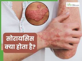 सोरायसिस क्या होता है? जानें इसके लक्षण, कारण और बचाव के उपाय सोरायसिस क्या होता है? जानें इसके लक्षण, कारण और बचाव के उपाय