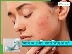क्या पिम्पल्स पर टूथपेस्ट लगाना चाहिए? जानिए स्किन पर कैसे असर डालता ये तरीका