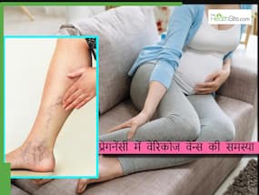इन कारणों से प्रेगनेंसी में हो सकती है वेरिकोज वेन्स की समस्या, एक्सपर्ट से जानिए आराम के उपाय