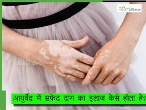 क्या आयुर्वेद की मदद से ठीक हो सकते हैं सफेद दाग? जानिए कैसे होता है विटिलिगो के इलाज