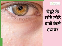 चेहरे पर छोटे-छोटे दानों से हैं परेशान तो आजमाएं ये 5 घरेलू उपाय, साफ और बेदाग दिखेगी स्किन