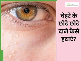चेहरे पर छोटे-छोटे दानों से हैं परेशान तो आजमाएं ये 5 घरेलू उपाय, साफ और बेदाग दिखेगी स्किन