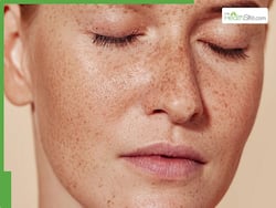 चेहरे पर झाइयां किस विटामिन की कमी से होती है? जानिए झाइयां कम करने वाली चीजें