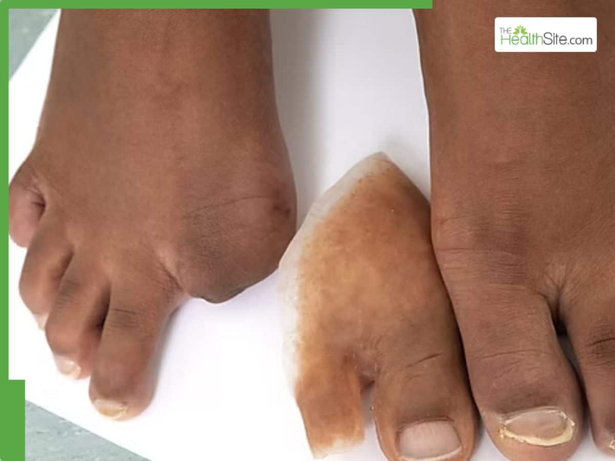 Man Loses Toe to This Commonly Overlooked Health Condition — Don’t Miss the Warning Signs