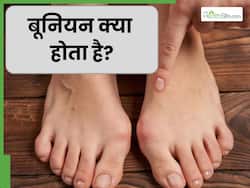 बूनियन (अंगूठे के पास हड्डी का उभार) क्या होता है? जानें इस समस्या के कारण और इलाज