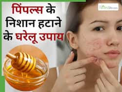 चेहरे पर एक भी दाना नहीं रहने देंगी आपके किचन में रखी ये 5 चीजें, साथ में दूर होंगे चेहरे के निशान