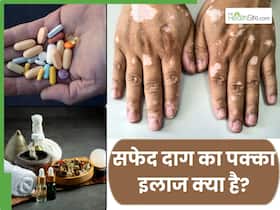 सफेद दाग का इलाज एलोपैथी में है या आयुर्वेद में? जानिए सफेद दाग का पक्का इलाज