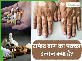 सफेद दाग का इलाज एलोपैथी में है या आयुर्वेद में? जानिए सफेद दाग का पक्का इलाज