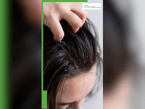 6 Best Ways To Prevent Dandruff And Ensure It Never Returns