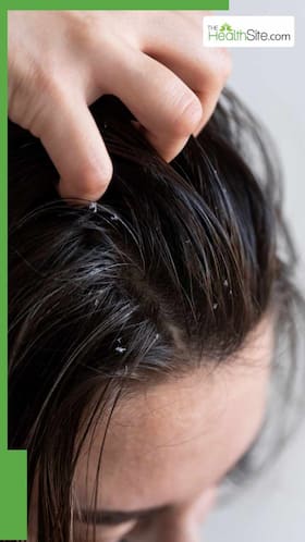 6 Best Ways To Prevent Dandruff And Ensure It Never Returns 6 Best Ways To Prevent Dandruff And Ensure It Never Returns
