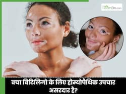 होम्योपैथी की कौन सी दवा से सफेद दाग सही होते है? जानिए पुराने विटिलिगो का इलाज क्या है?